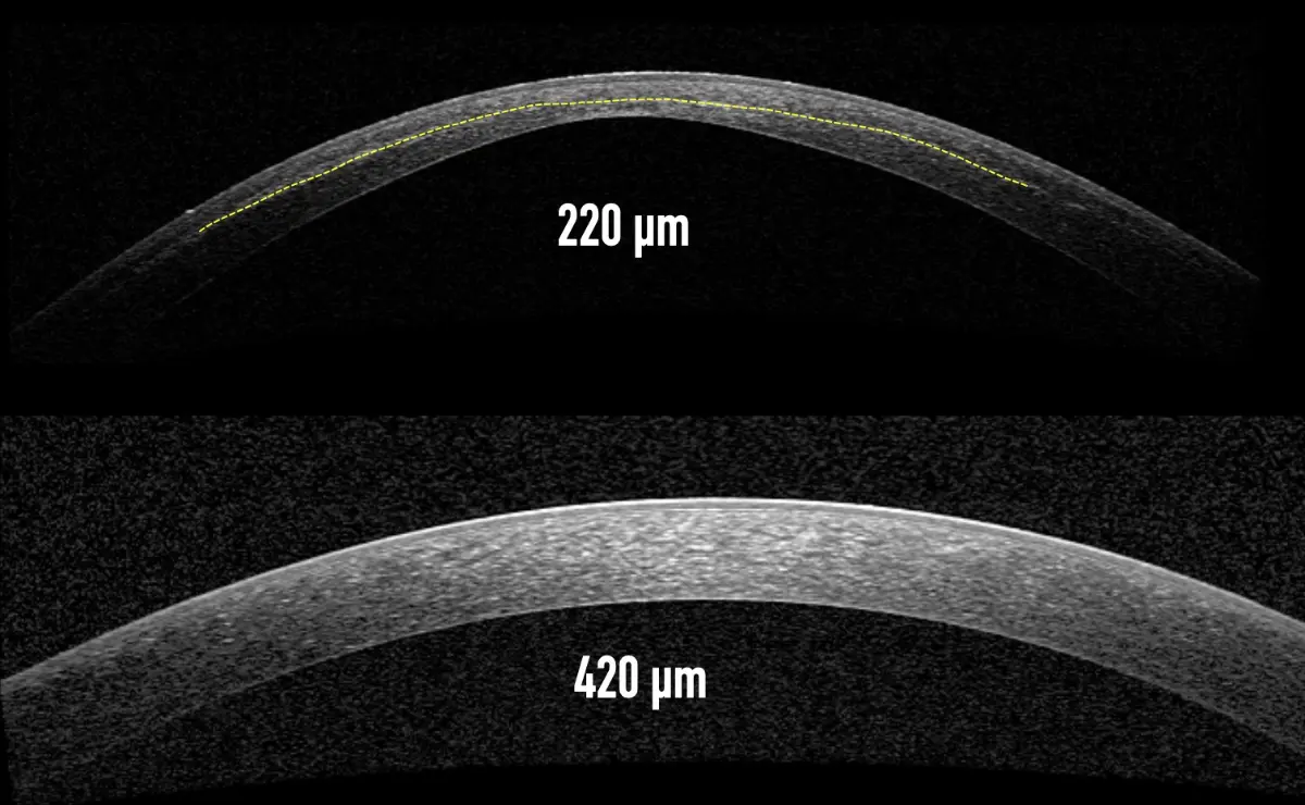 Different refractive procedures remove or reshape corneal tissue in different ways. 