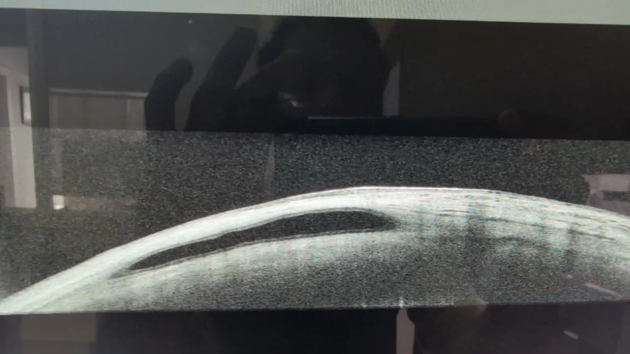 the picture is showing suture on the scleral flap under conjuctiva 