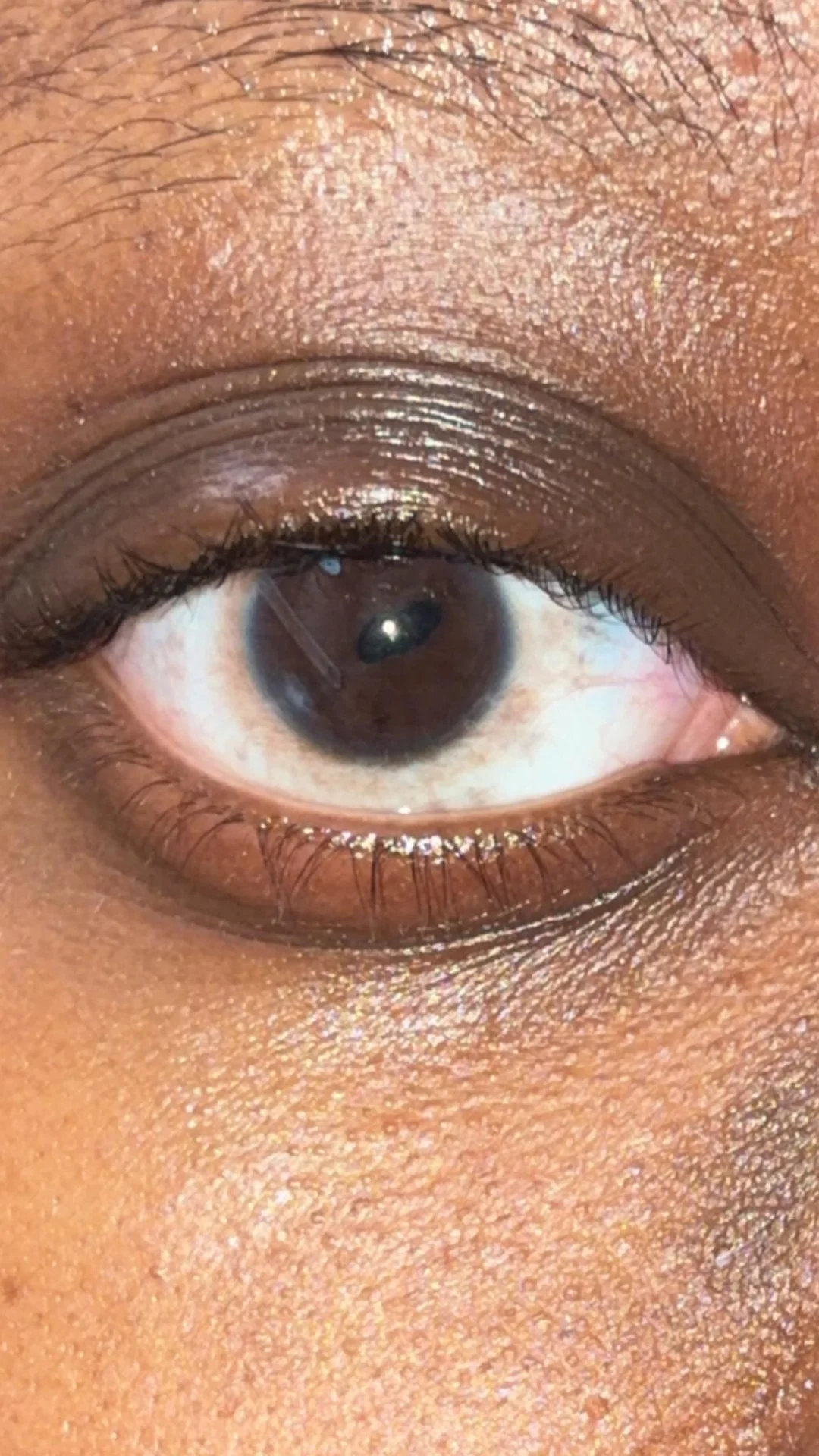 the picture is showing suture on the scleral flap under conjuctiva 