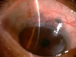 the picture is showing suture on the scleral flap under conjuctiva 