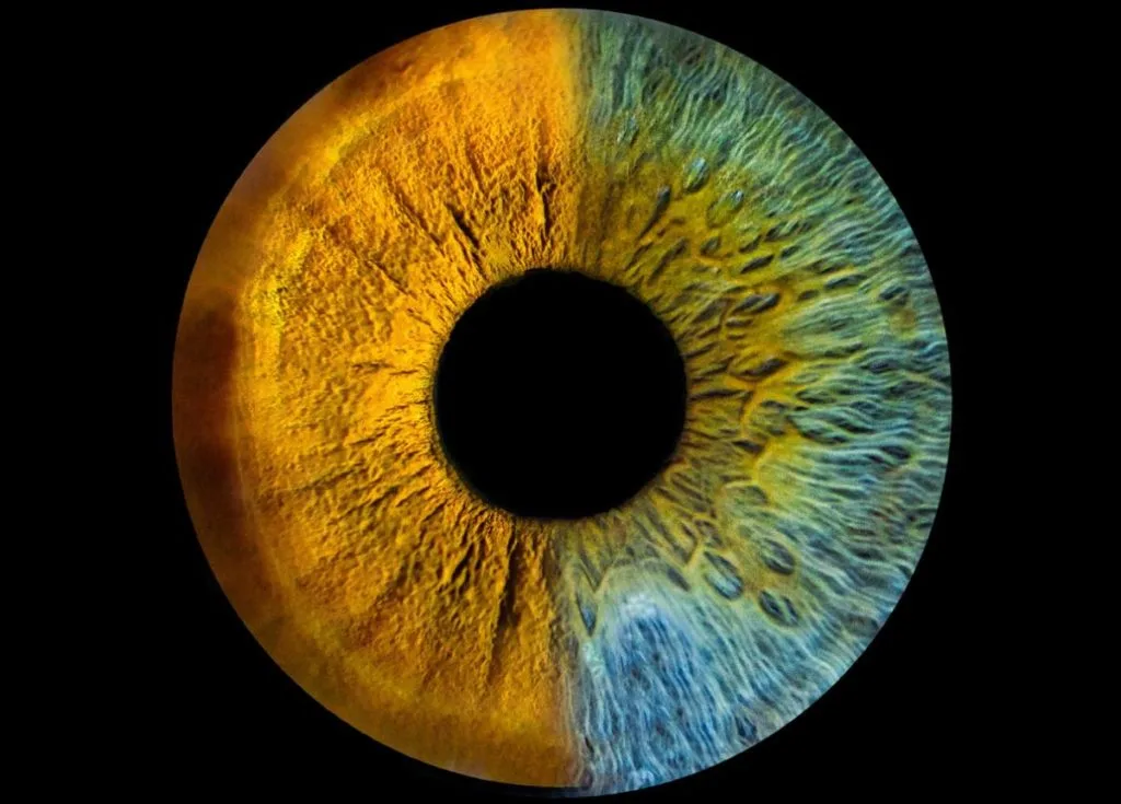 the picture is showing an eye with different colors and is it possible to change the color of your eyes permanently 