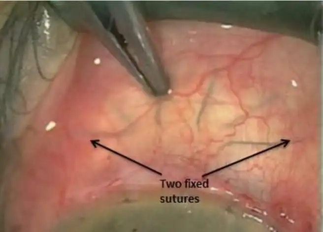 the picture is showing suture on the scleral flap under conjuctiva 