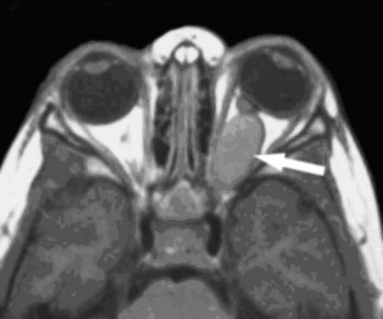 The glioma can be found as an incidental finding on a MRI.