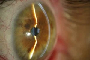 the picture is showing an eye with small pupiland slitlamp beam is falling on the cornea and iris 
