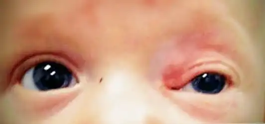 port wine stain or capillary hemangioma on the forehead involving eye should not be ignored. It might cause secondry glaucoma